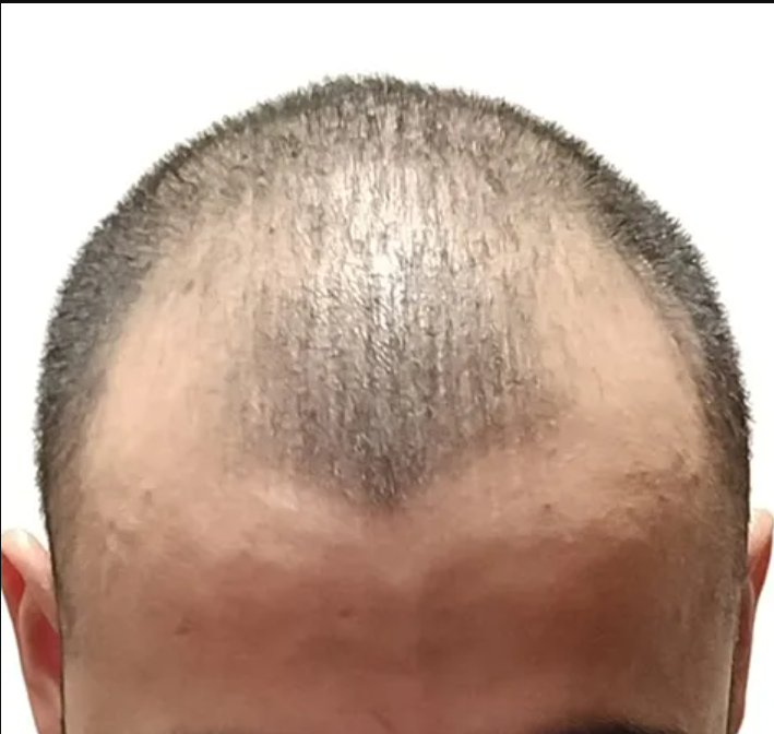 Does creatine cause hair loss