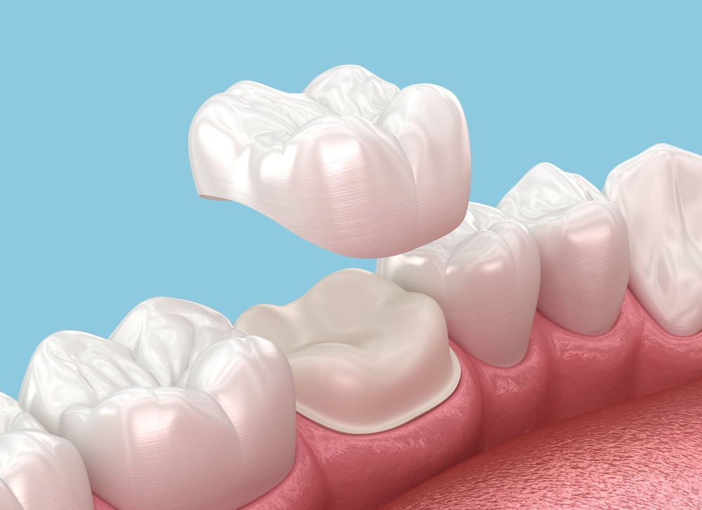 definition dental crowns