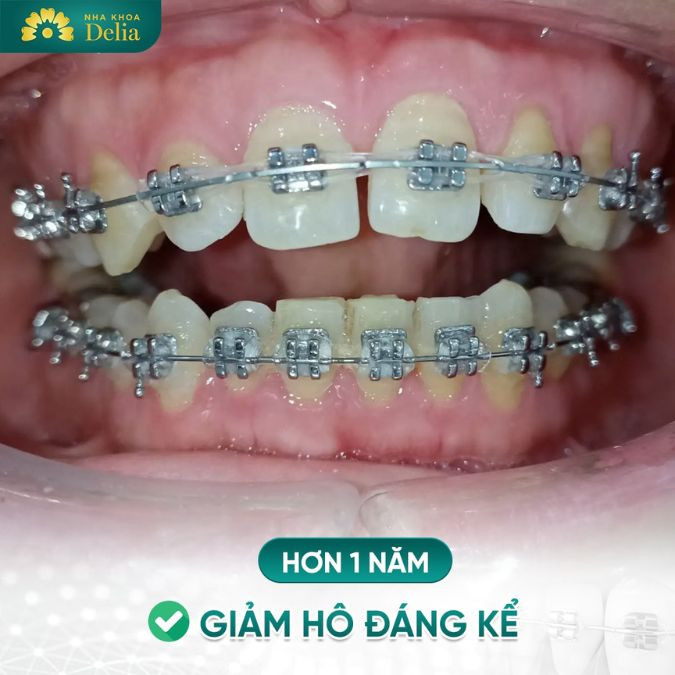 Niềng răng - Khôi phục vị trí răng