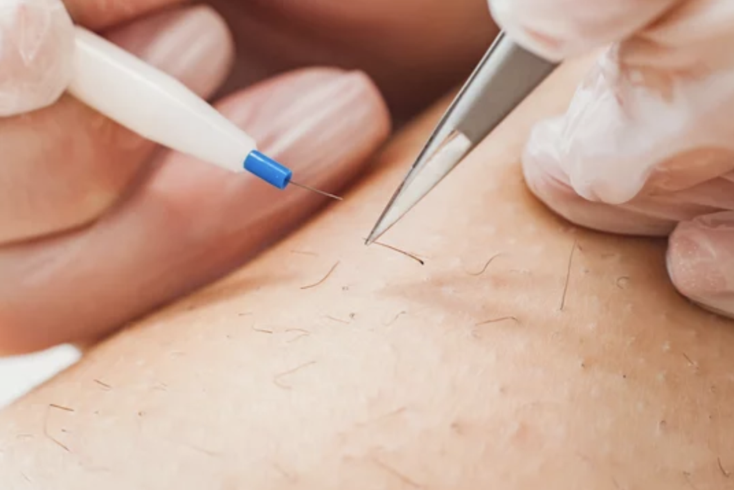 A picture of an electrologist doing electrolysis hair removal on someone