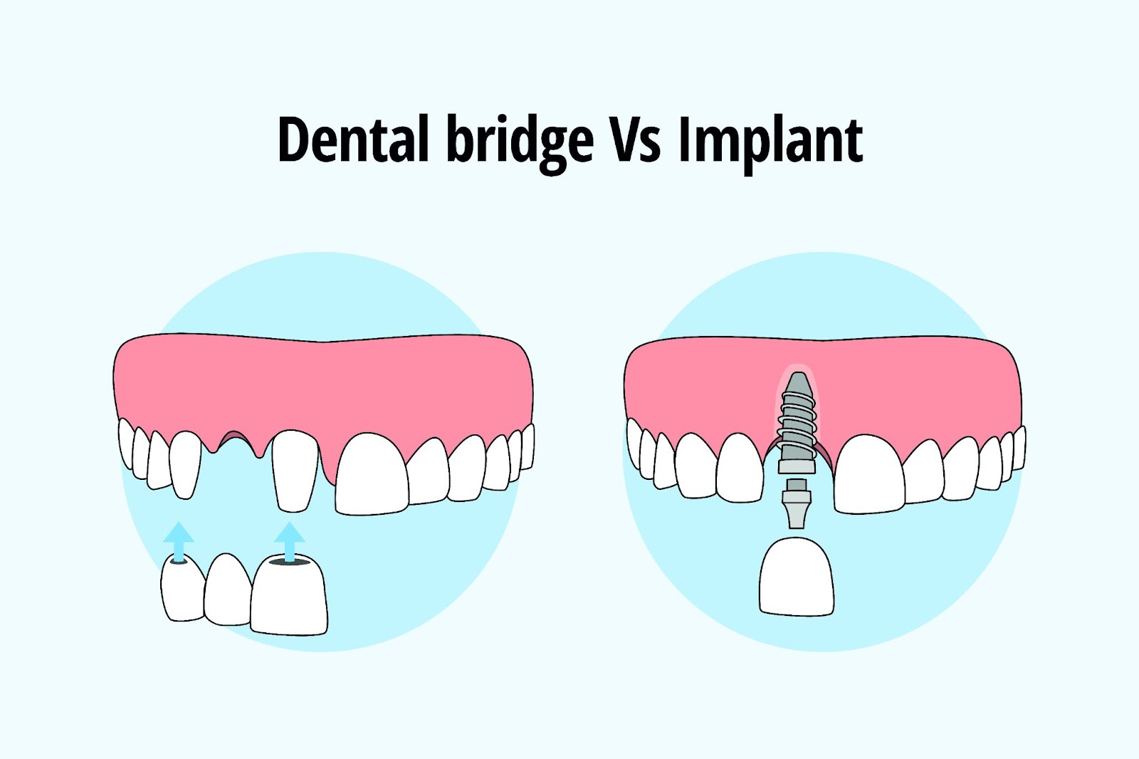 Infographic comparing a permanent dental bridge and a dental implant to replace a missing tooth.