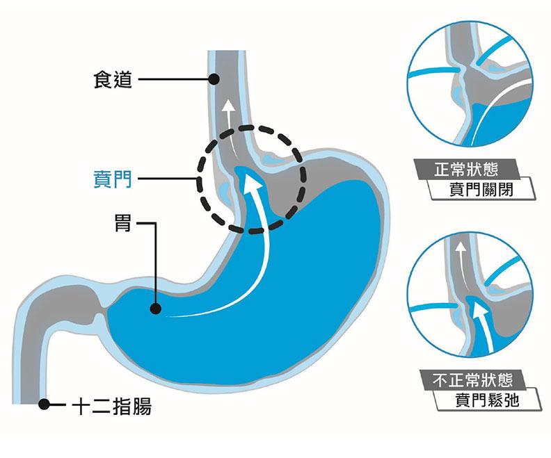 胃食道逆流示意圖。