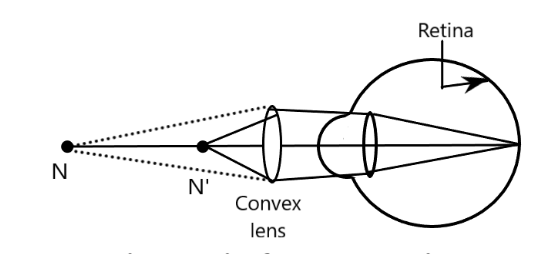 Eye with convex lens to correct Hypermetropia