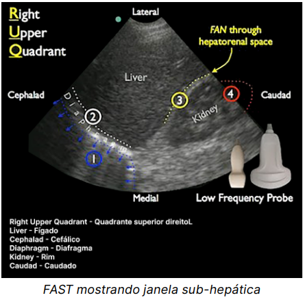 FAST Exame trauma abdominal