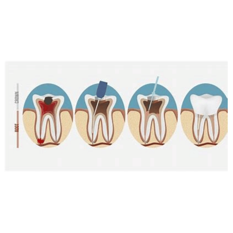 Root Canal FAQs Answered by SmileStudio Experts