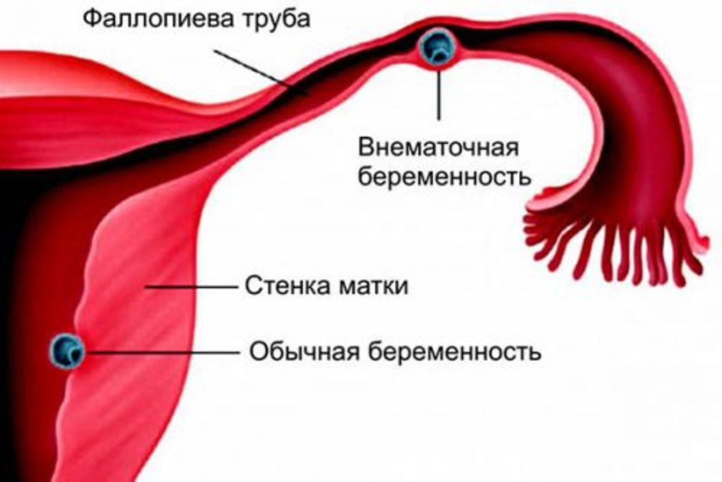 признаки внематочной беременности