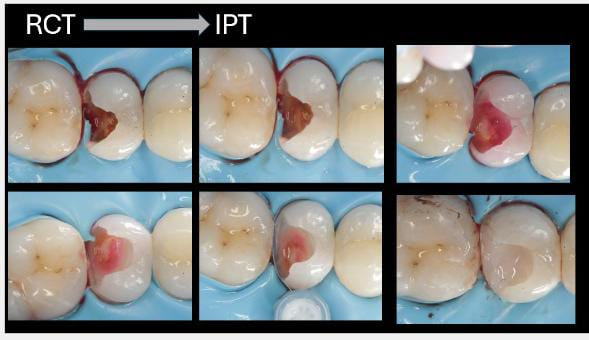 Root Canals