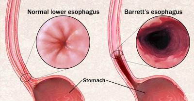 Barret’s Oesophagus