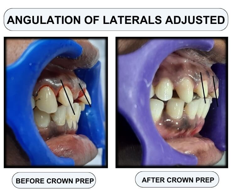 laterals adjusted