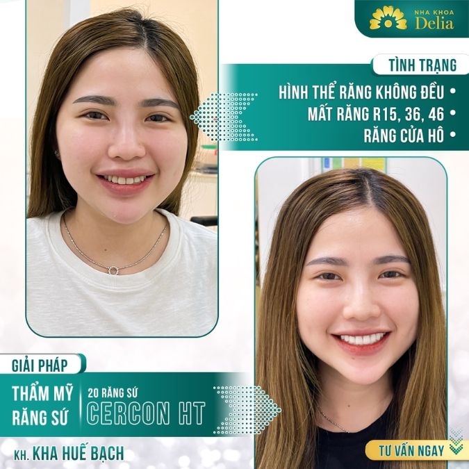 Răng sứ Cercon HT là gì?