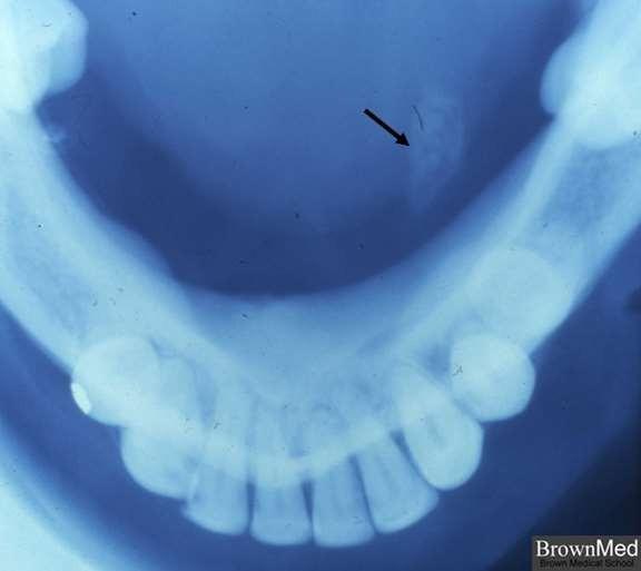 C:\Users\pc\Desktop\sialolithiasis2.jpg