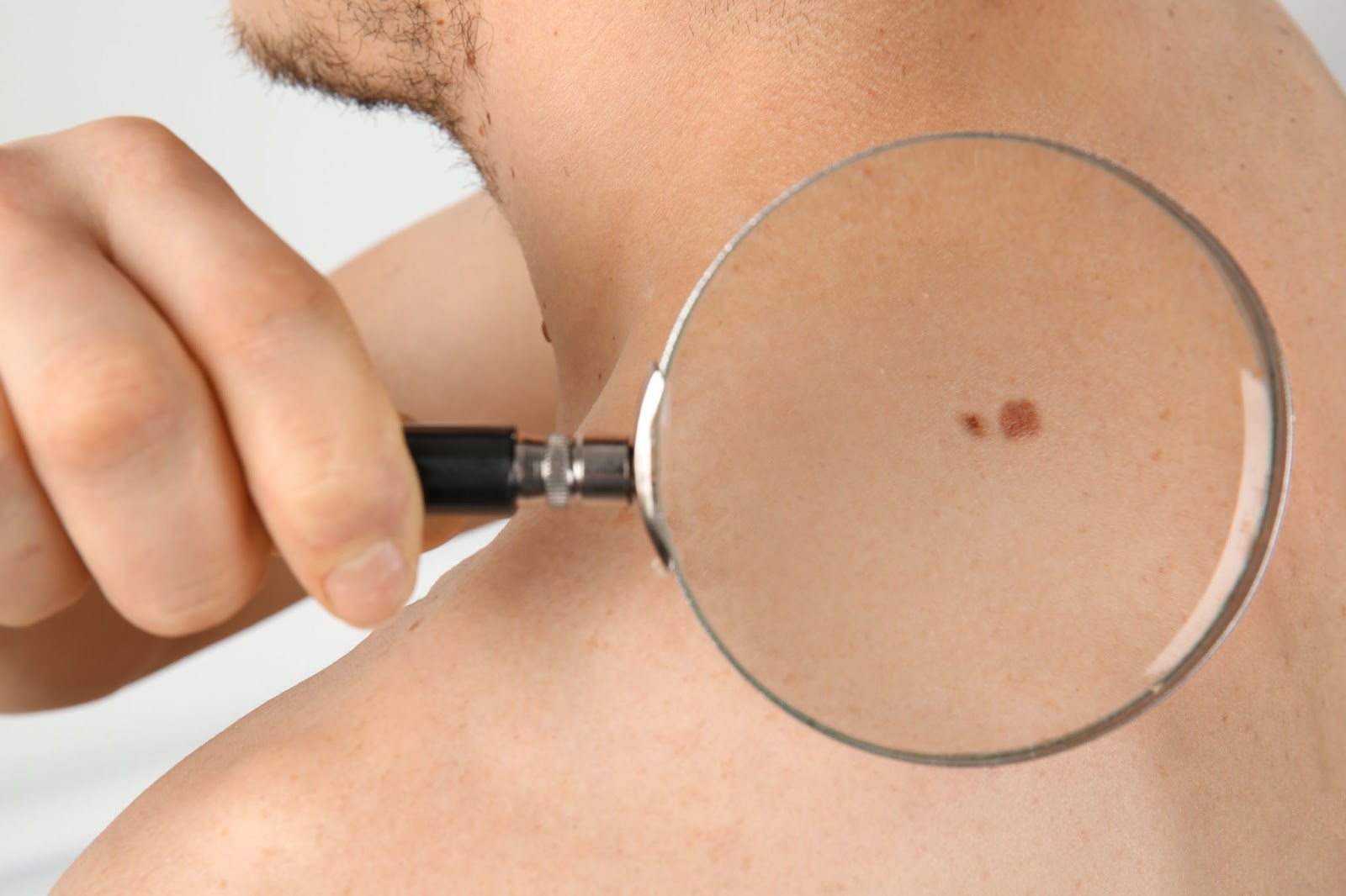 how to remove skin tags in one night