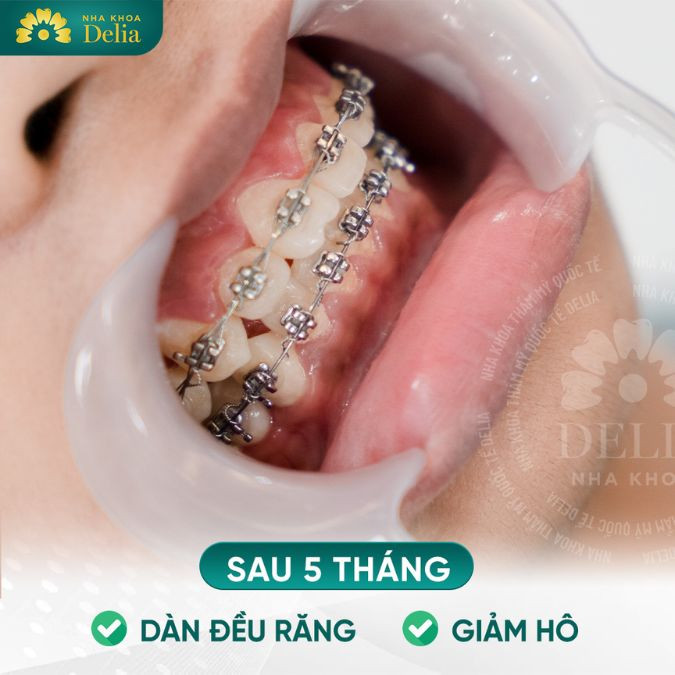 Trong trường hợp sai lệch khớp cắn như răng hô, móm, khấp khểnh,.. thời gian và kỹ thuật niềng răng cũng sẽ lâu hơn