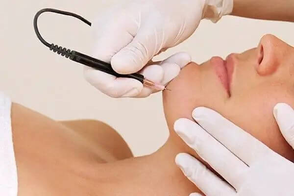 Lady receiving electrolysis permanent hair removal on the chin