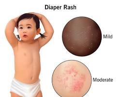 Image of Nappy Rash
