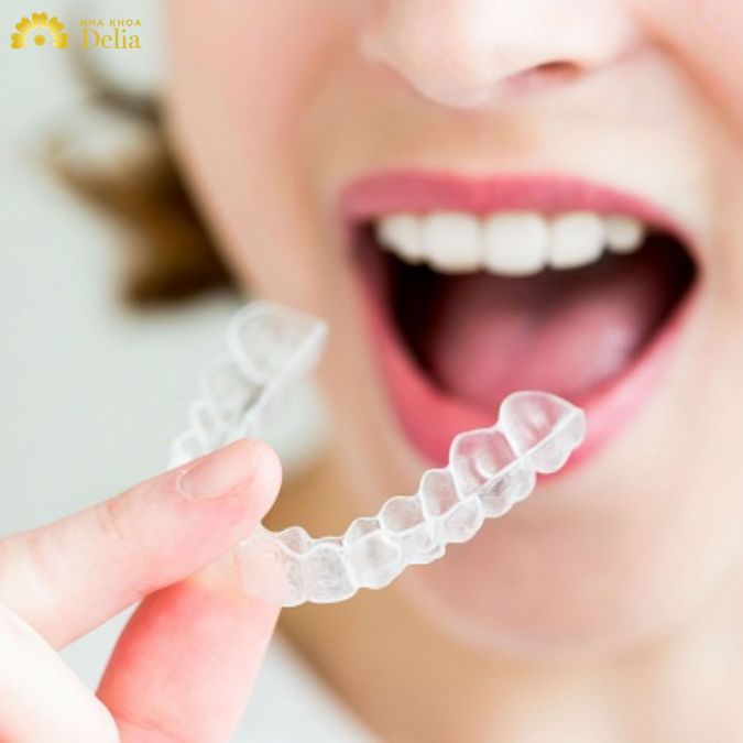 Niềng răng không mắc cài hay còn được biết là niềng răng khay trong suốt - Invisalign