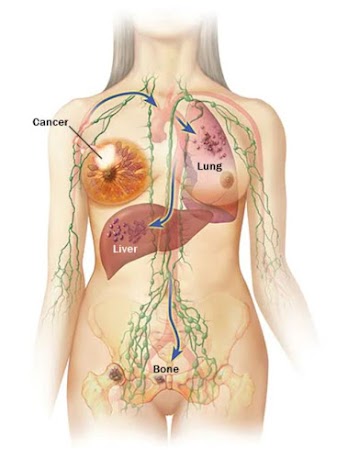 Le cancer du sein a un tropisme pour le poumon, le foie et les os en particulier