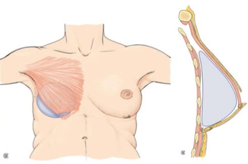 Implantation sous pectorale de la prothèse
