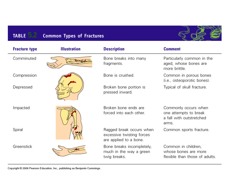 Bone fractures 


